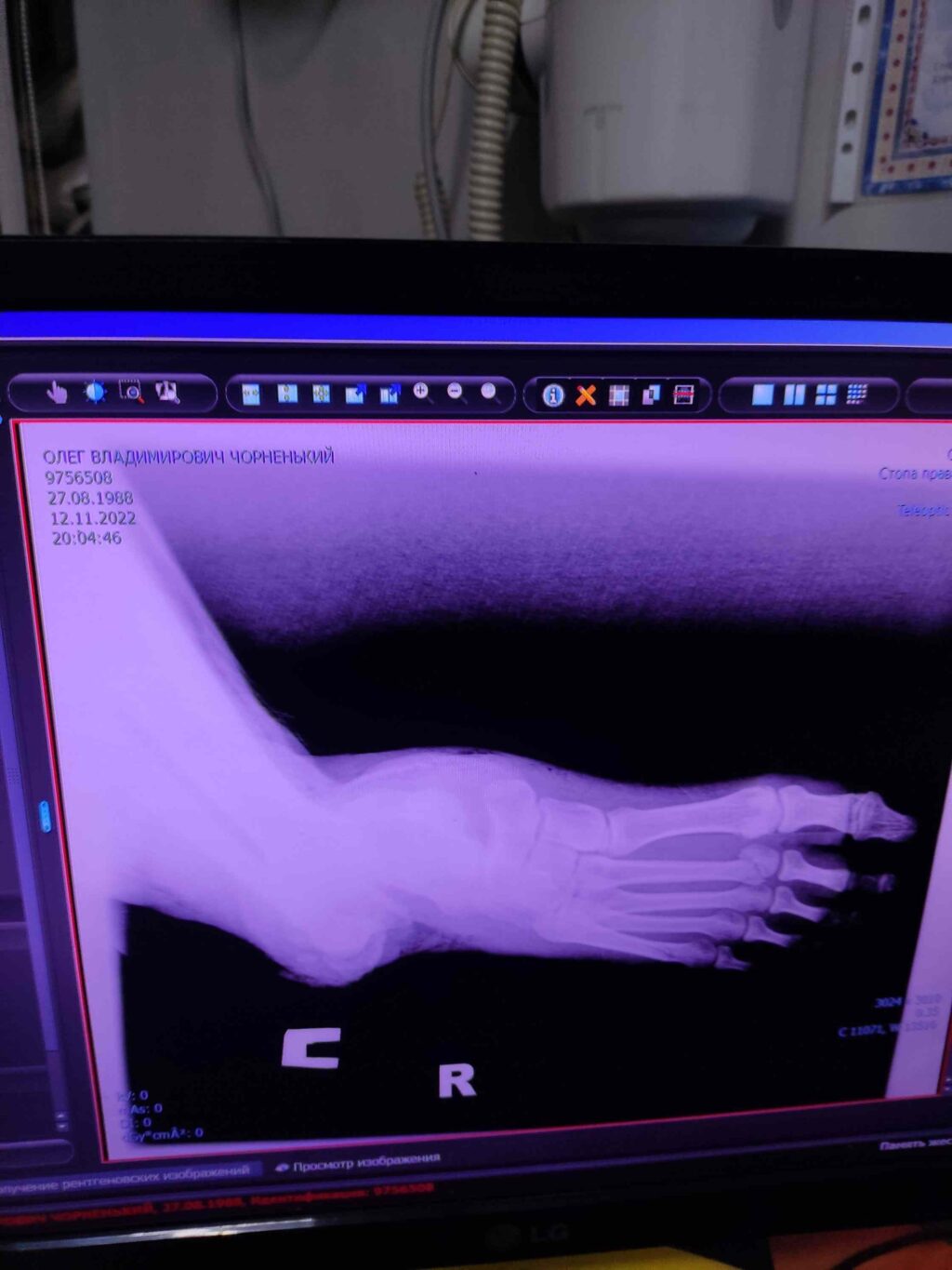 Думав, поранену ногу не вдасться врятувати, вона гноїлася і гнила: як нацпрограма #ВрятуйКінцівку бореться з ампутаціями