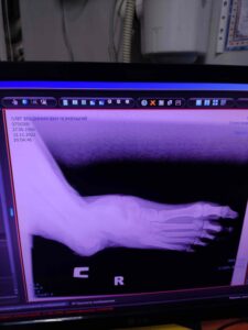 Думав, поранену ногу не вдасться врятувати, вона гноїлася і гнила: як нацпрограма #ВрятуйКінцівку бореться з ампутаціями